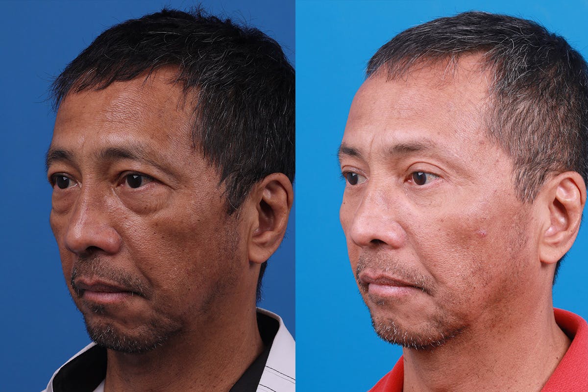 Dermal Fillers Before & After Gallery - Patient 184320289 - Image 4