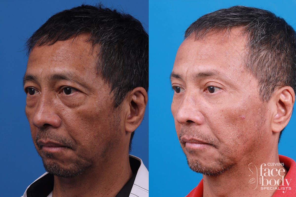 Eyelid Surgery Before & After Gallery - Patient 112478 - Image 4