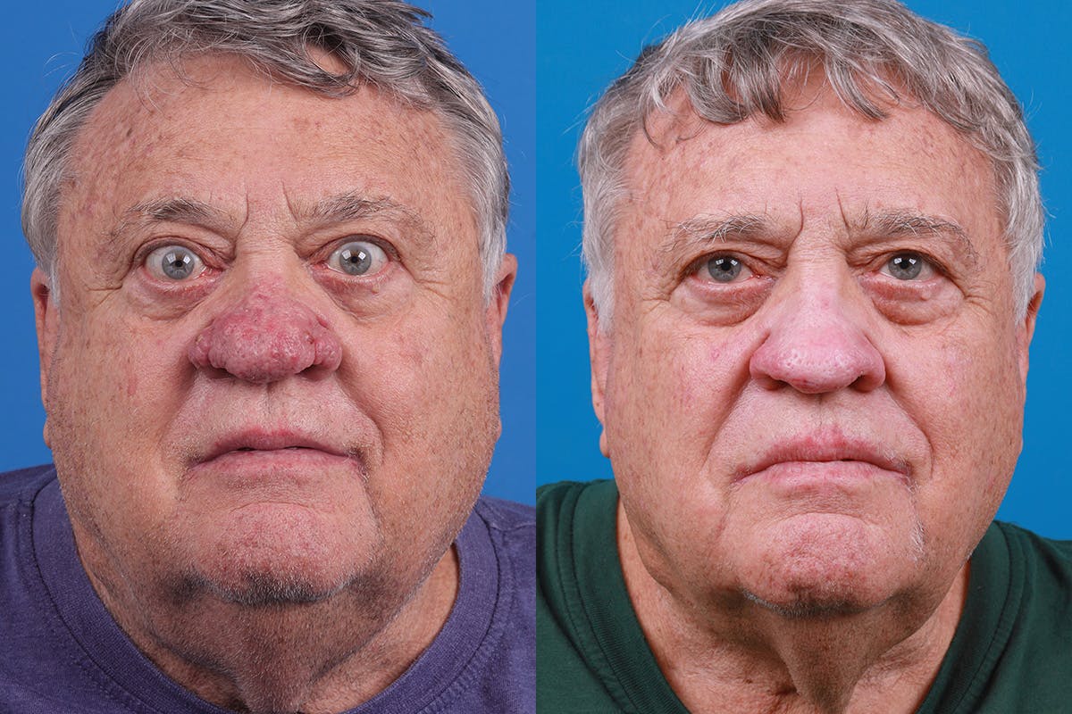 Rhinophyma Before & After Gallery - Patient 184320148 - Image 1