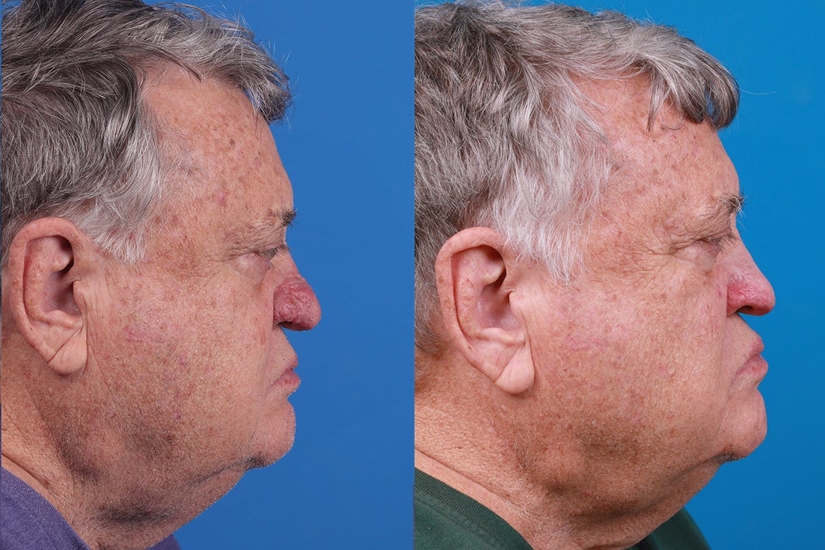 Rhinophyma Before & After Gallery - Patient 184320148 - Image 3