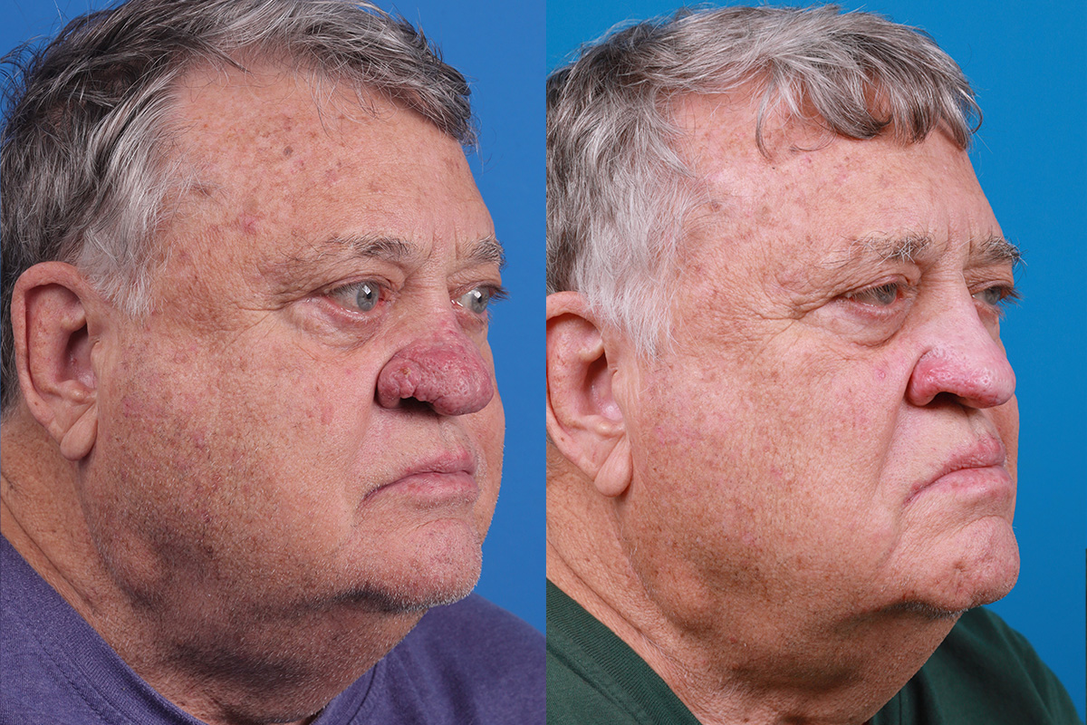 Rhinophyma Before & After Gallery - Patient 184320148 - Image 2