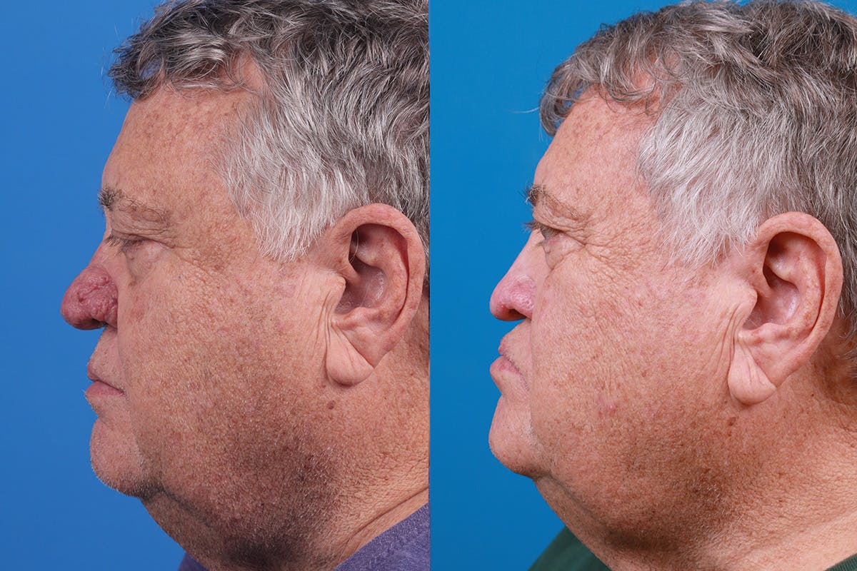 Rhinophyma Before & After Gallery - Patient 184320148 - Image 5
