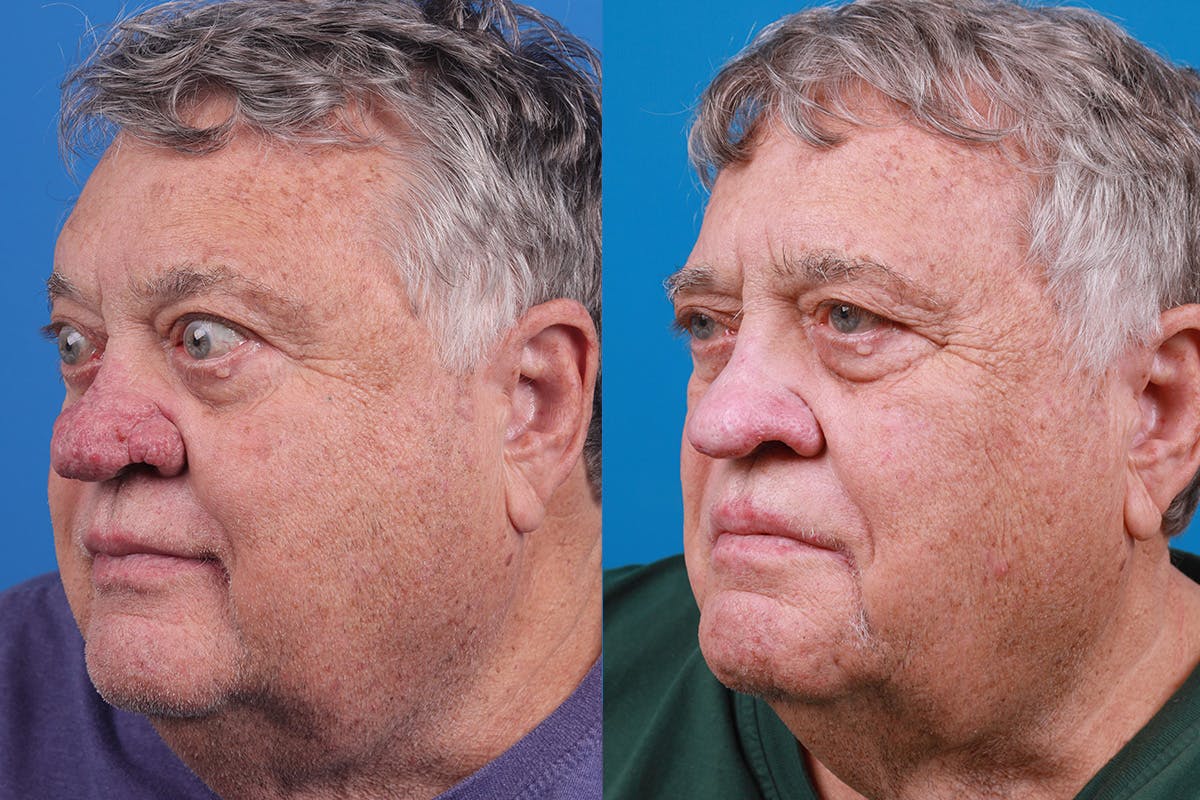 Rhinophyma Before & After Gallery - Patient 184320148 - Image 4