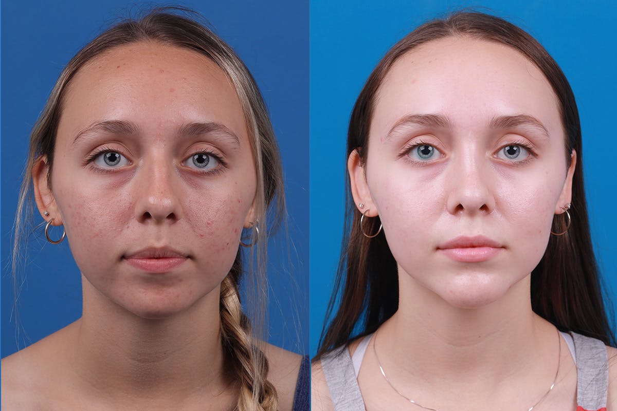 Chin Augmentation Before & After Gallery - Patient 184320145 - Image 2