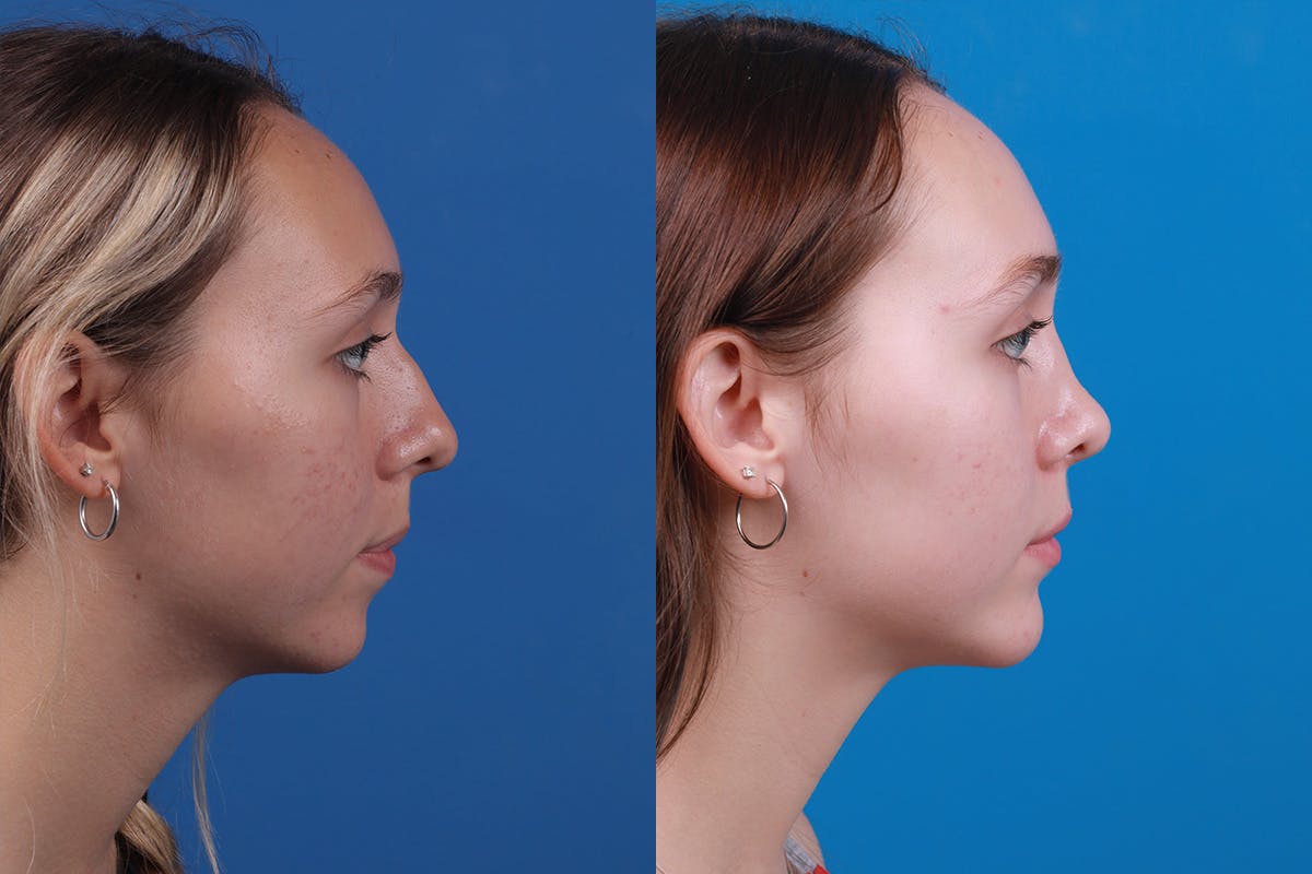 Chin Augmentation Before & After Gallery - Patient 184320145 - Image 4