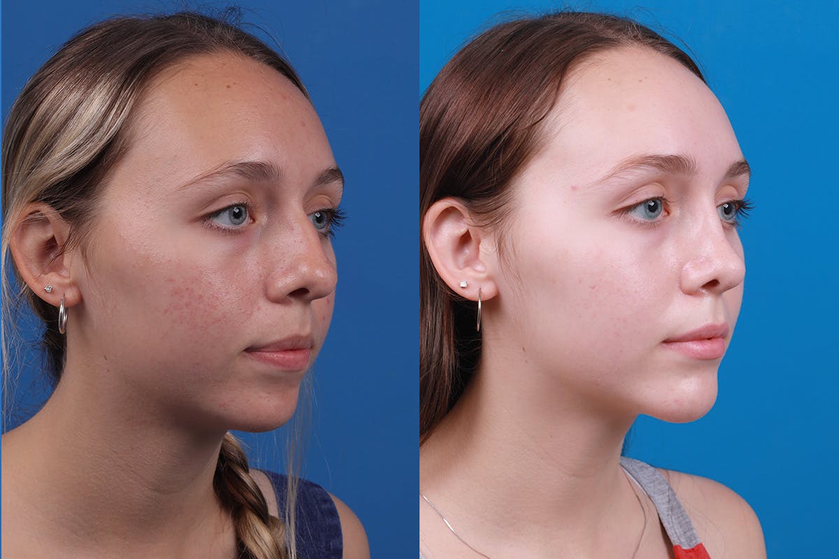 Chin Augmentation Before & After Gallery - Patient 184320145 - Image 3