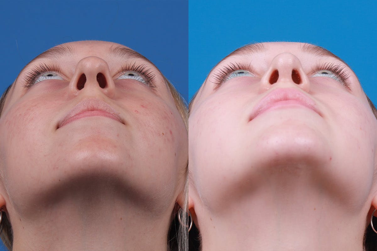 Rhinoplasty Before & After Gallery - Patient 184320141 - Image 6