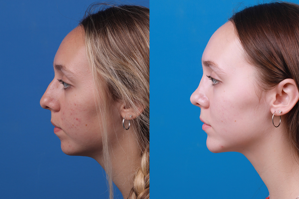 Chin Augmentation Before & After Gallery - Patient 184320145 - Image 1
