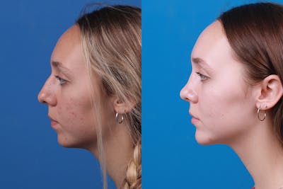 Chin Augmentation Before & After Gallery - Patient 184320145 - Image 1