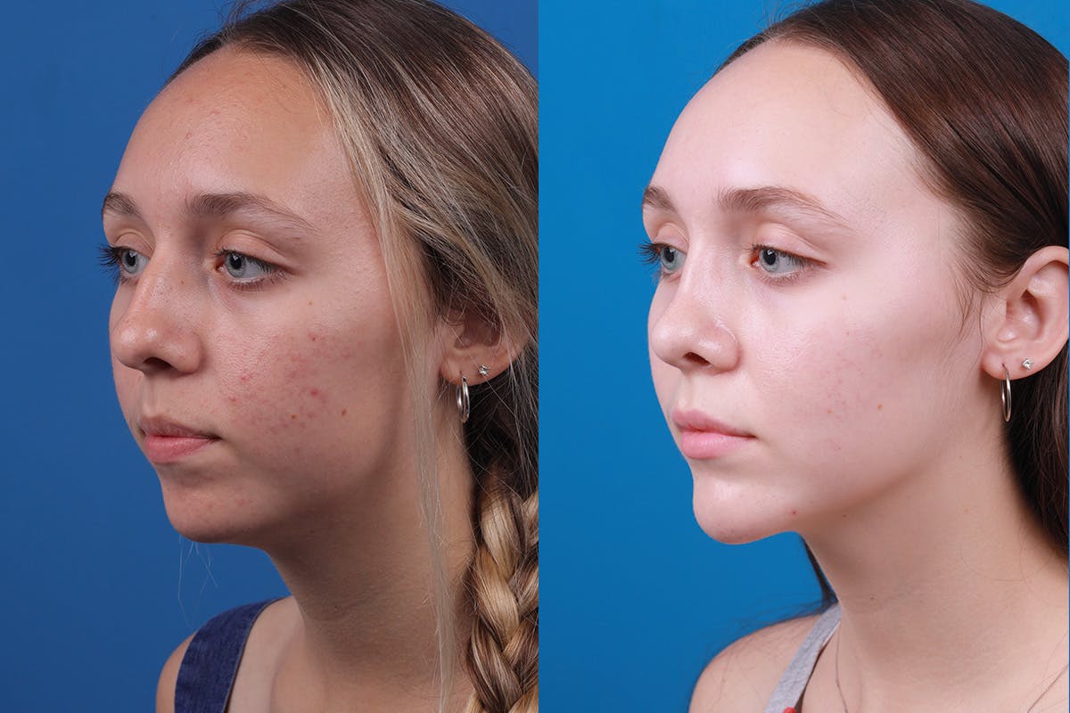 Rhinoplasty Before & After Gallery - Patient 184320141 - Image 4