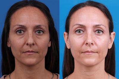 Rhinoplasty Before & After Gallery - Patient 188712747 - Image 1