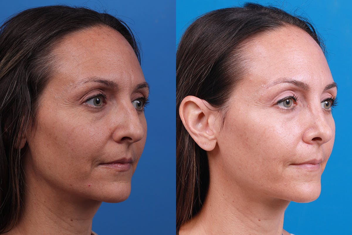 Rhinoplasty Before & After Gallery - Patient 188712747 - Image 2