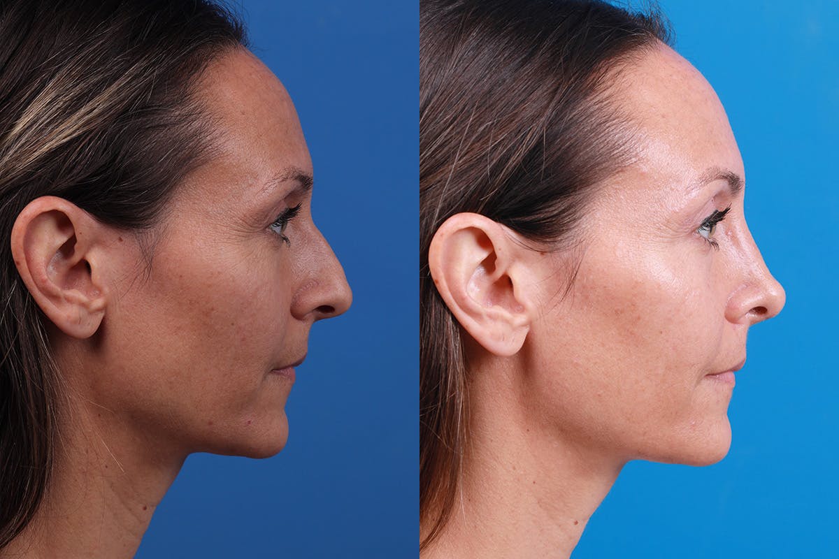 Rhinoplasty Before & After Gallery - Patient 188712747 - Image 3