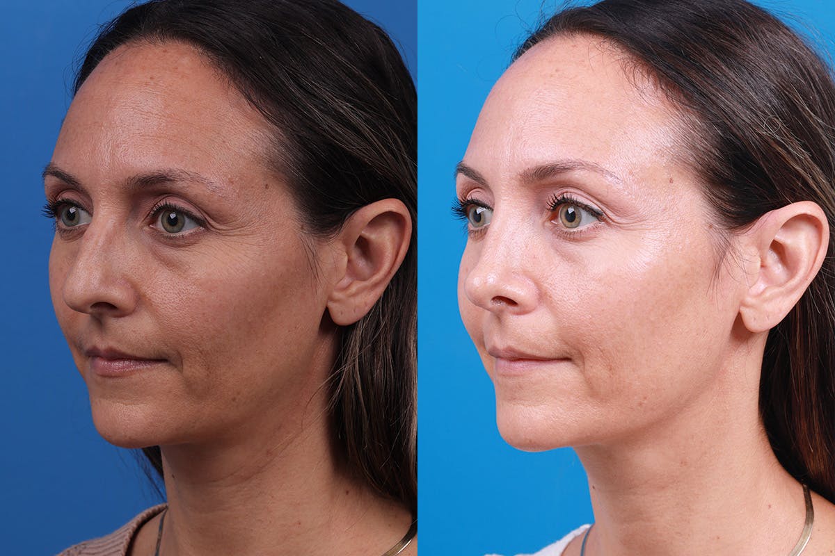Rhinoplasty Before & After Gallery - Patient 188712747 - Image 4