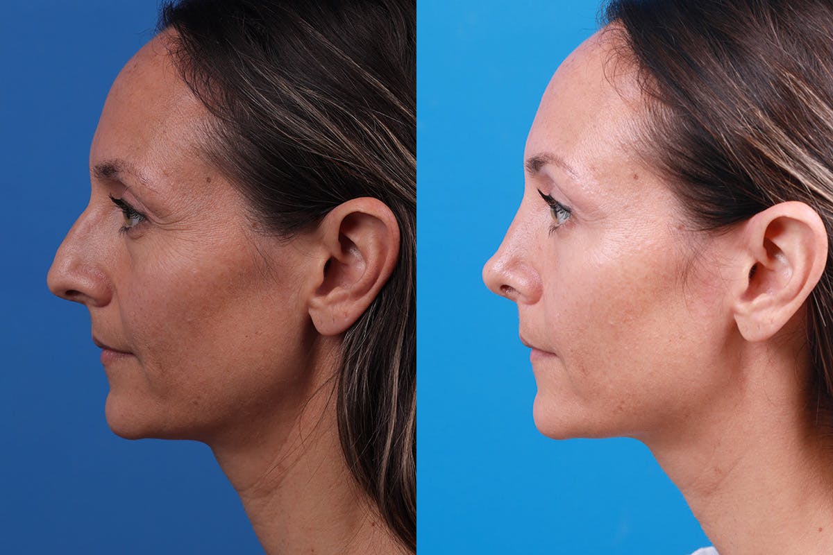 Rhinoplasty Before & After Gallery - Patient 188712747 - Image 5