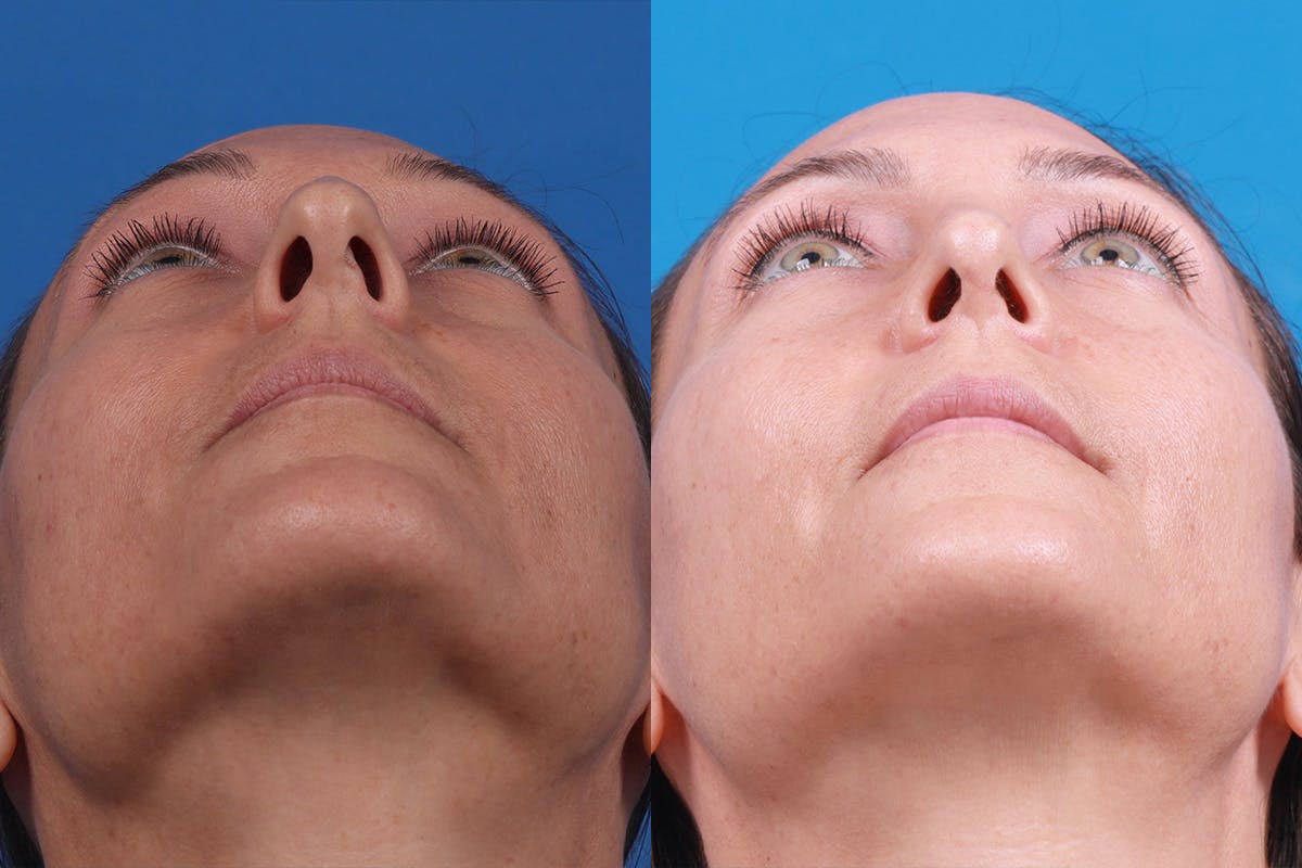 Rhinoplasty Before & After Gallery - Patient 188712747 - Image 6