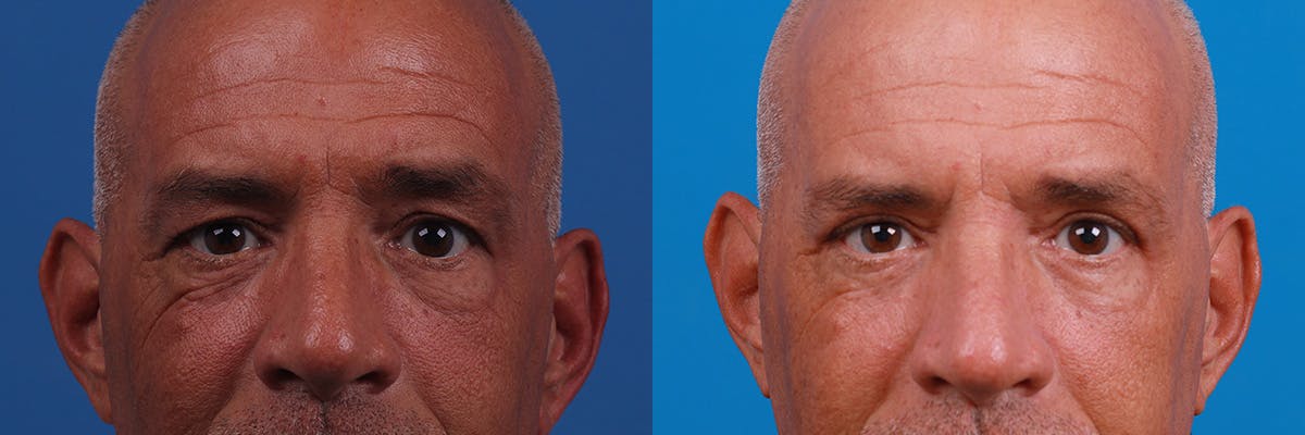 Eyelid Surgery Before & After Gallery - Patient 188712809 - Image 1