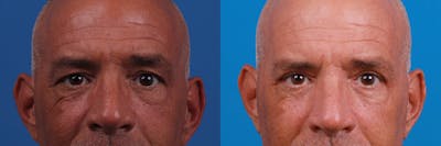 Eyelid Surgery Before & After Gallery - Patient 188712809 - Image 1