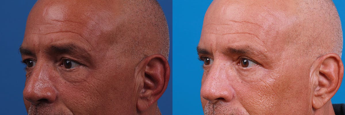 Eyelid Surgery Before & After Gallery - Patient 188712809 - Image 3