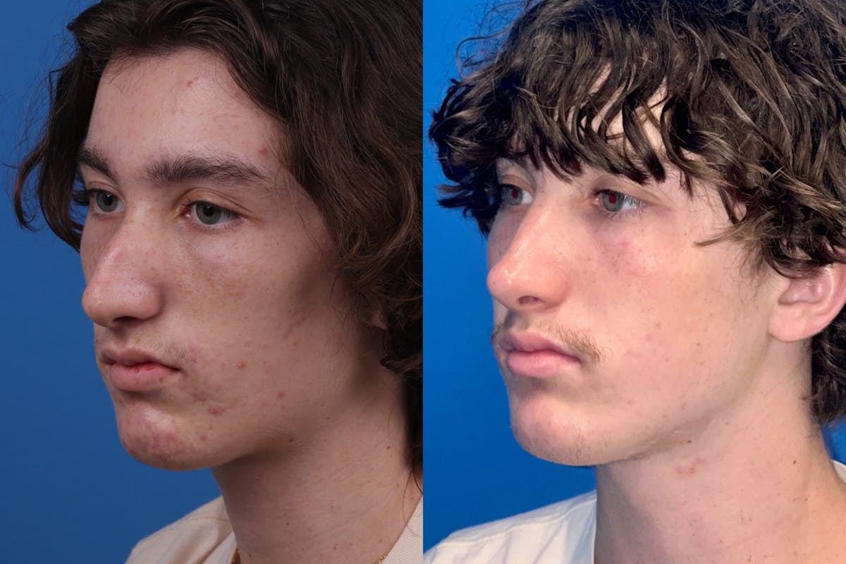 Male Rhinoplasty Before & After Gallery - Patient 386165 - Image 2