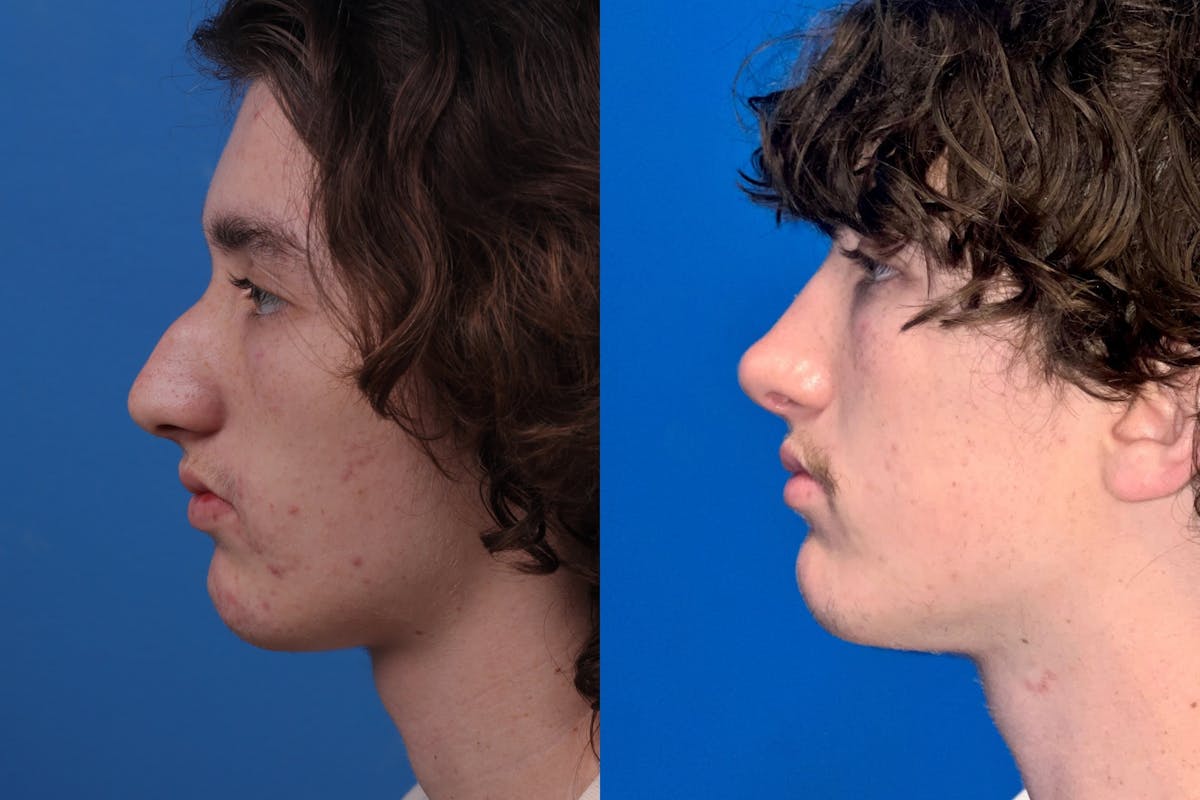 Rhinoplasty Before & After Gallery - Patient 159366 - Image 3