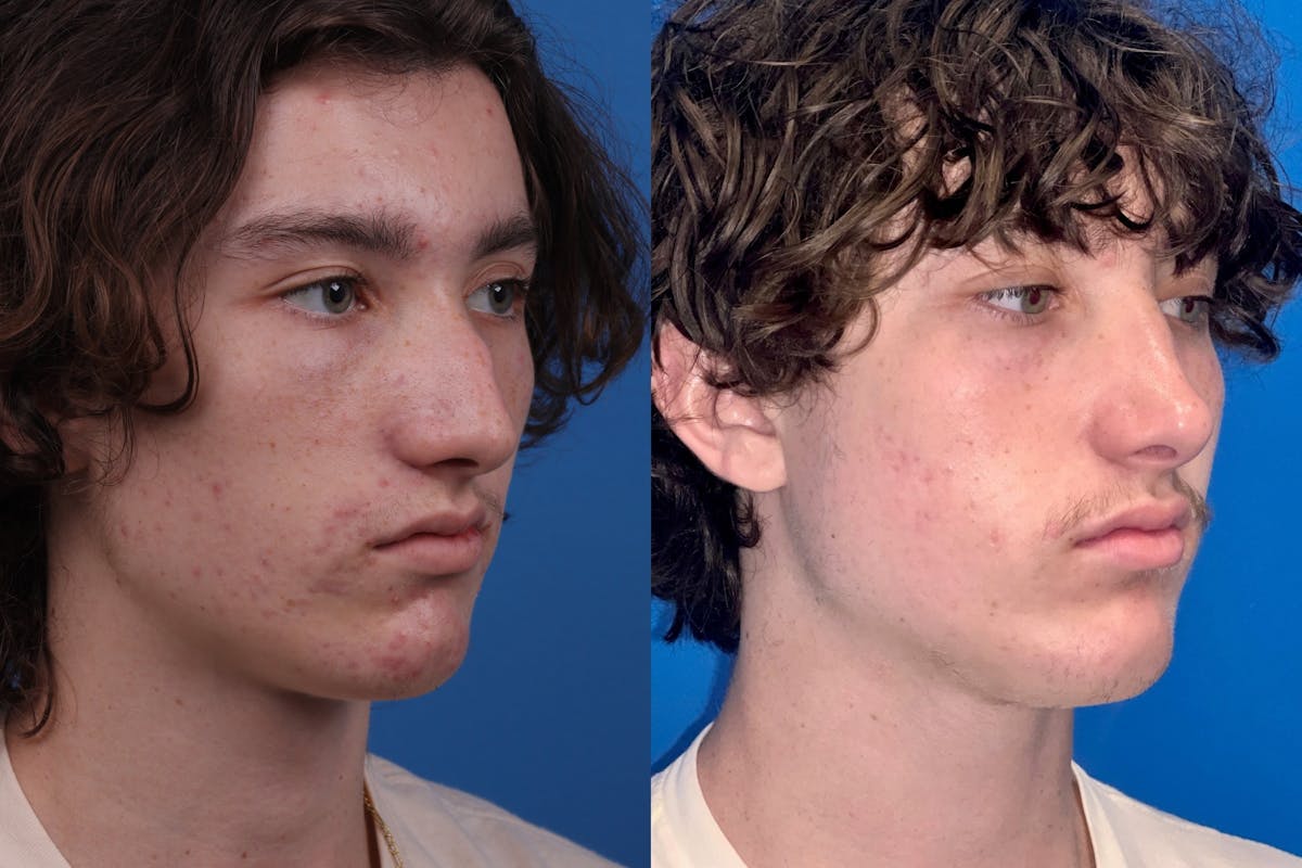 Male Rhinoplasty Before & After Gallery - Patient 386165 - Image 4