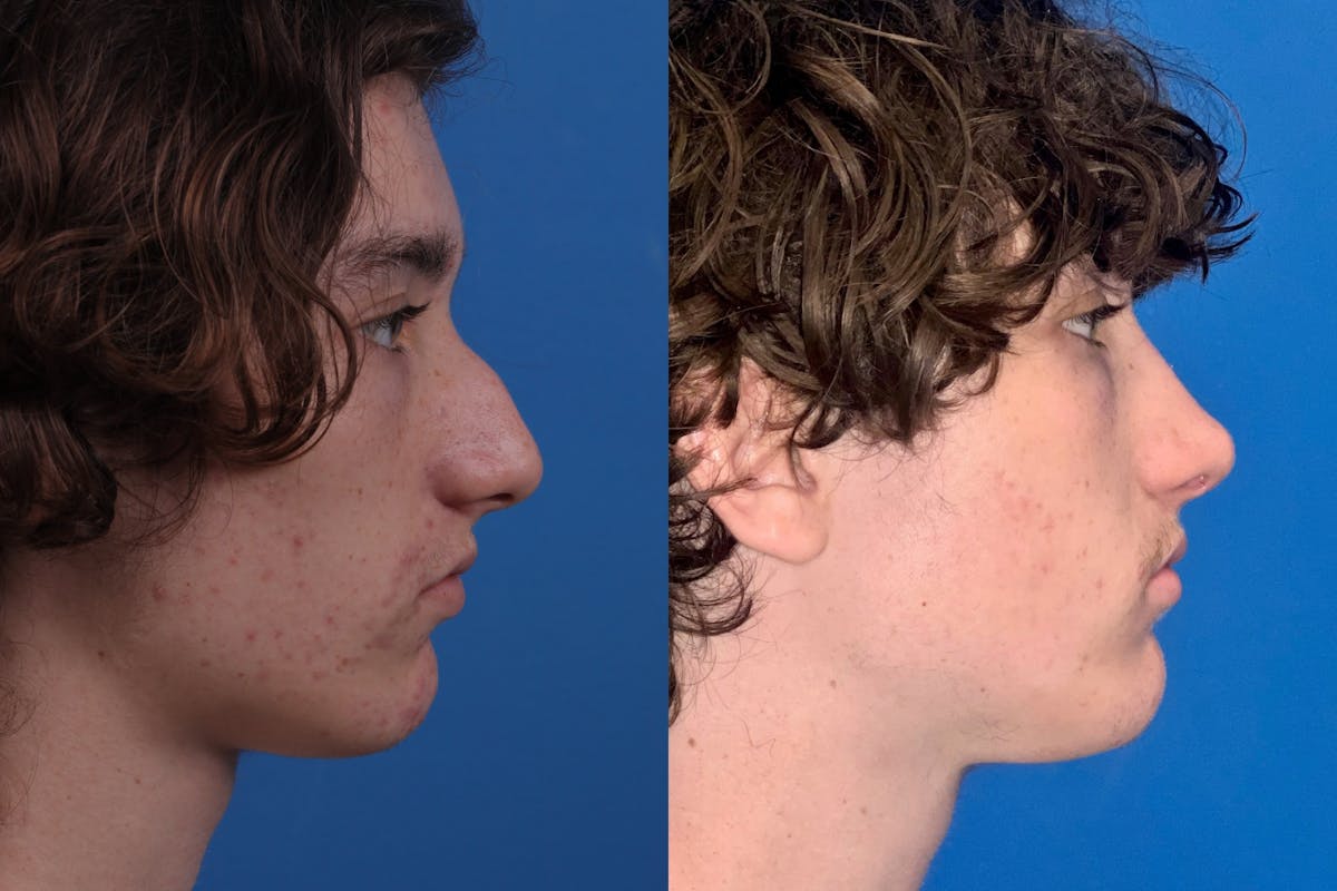 Male Rhinoplasty Before & After Gallery - Patient 386165 - Image 5
