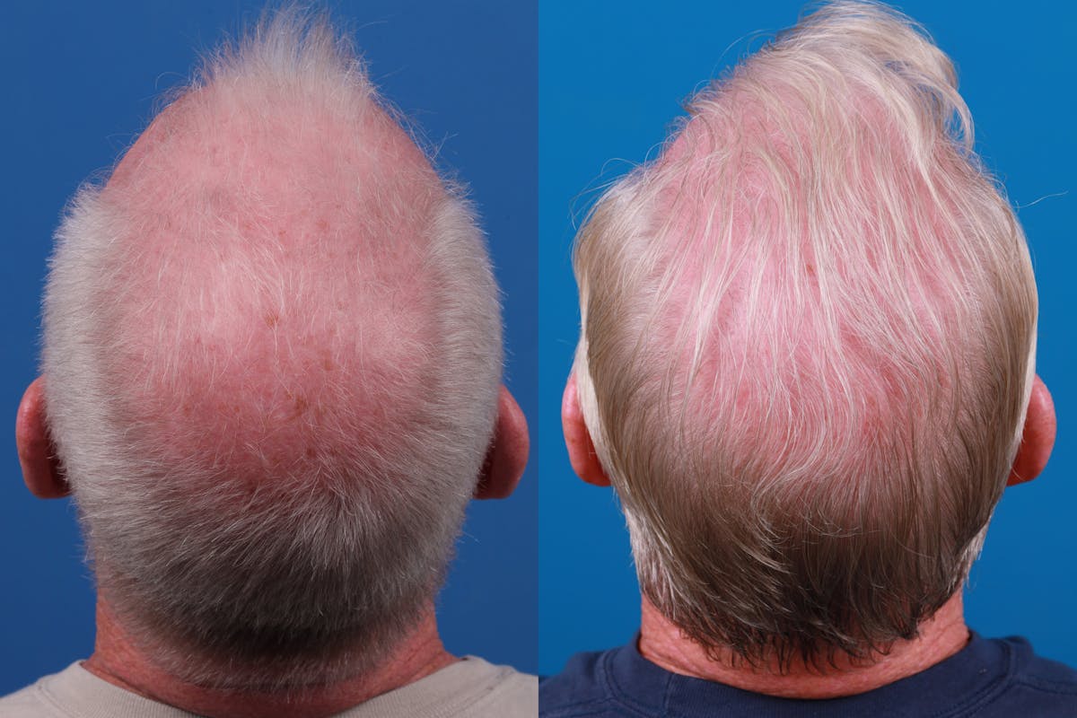 Hair Restoration Before & After Gallery - Patient 286463 - Image 1