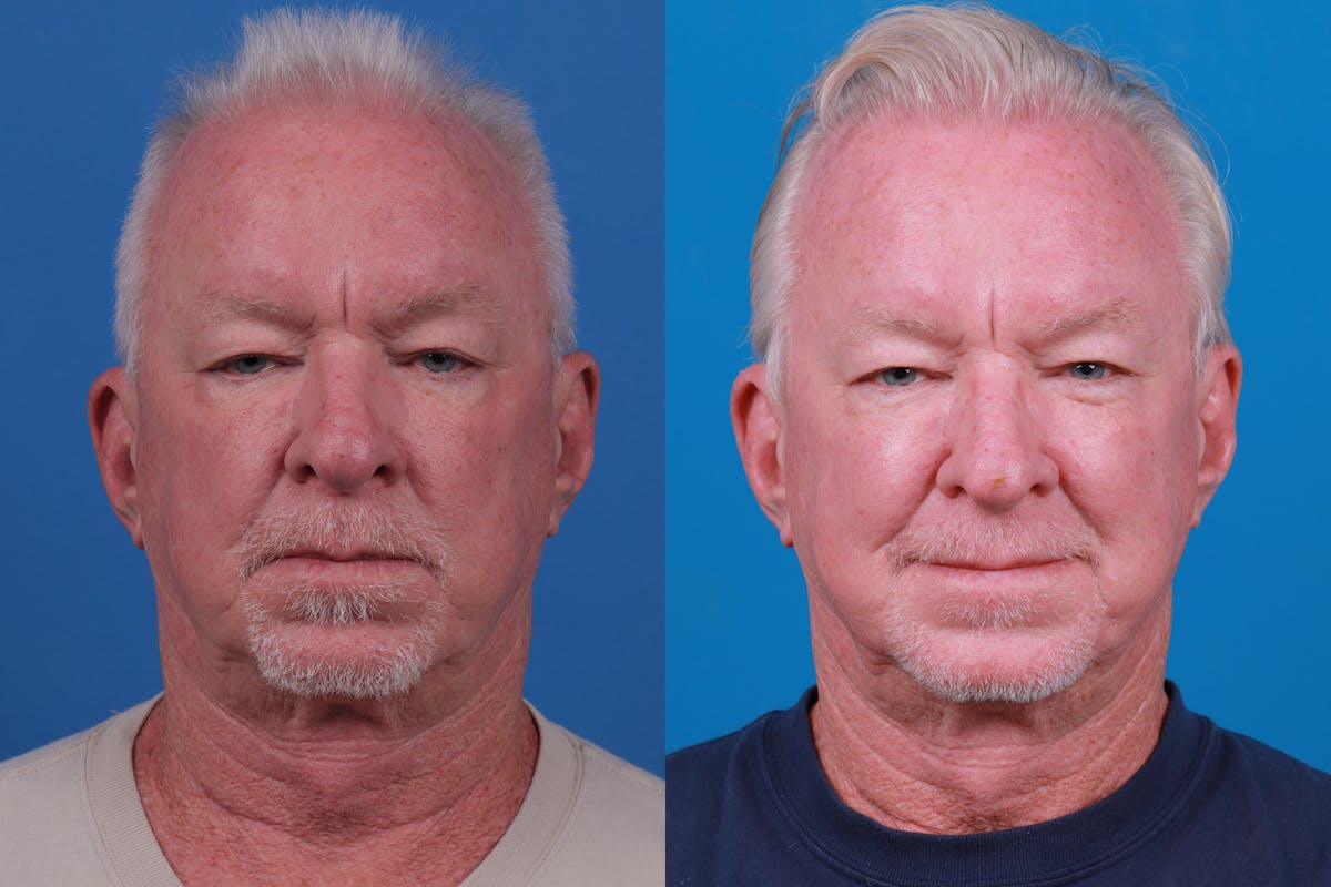 Hair Restoration Before & After Gallery - Patient 286463 - Image 2