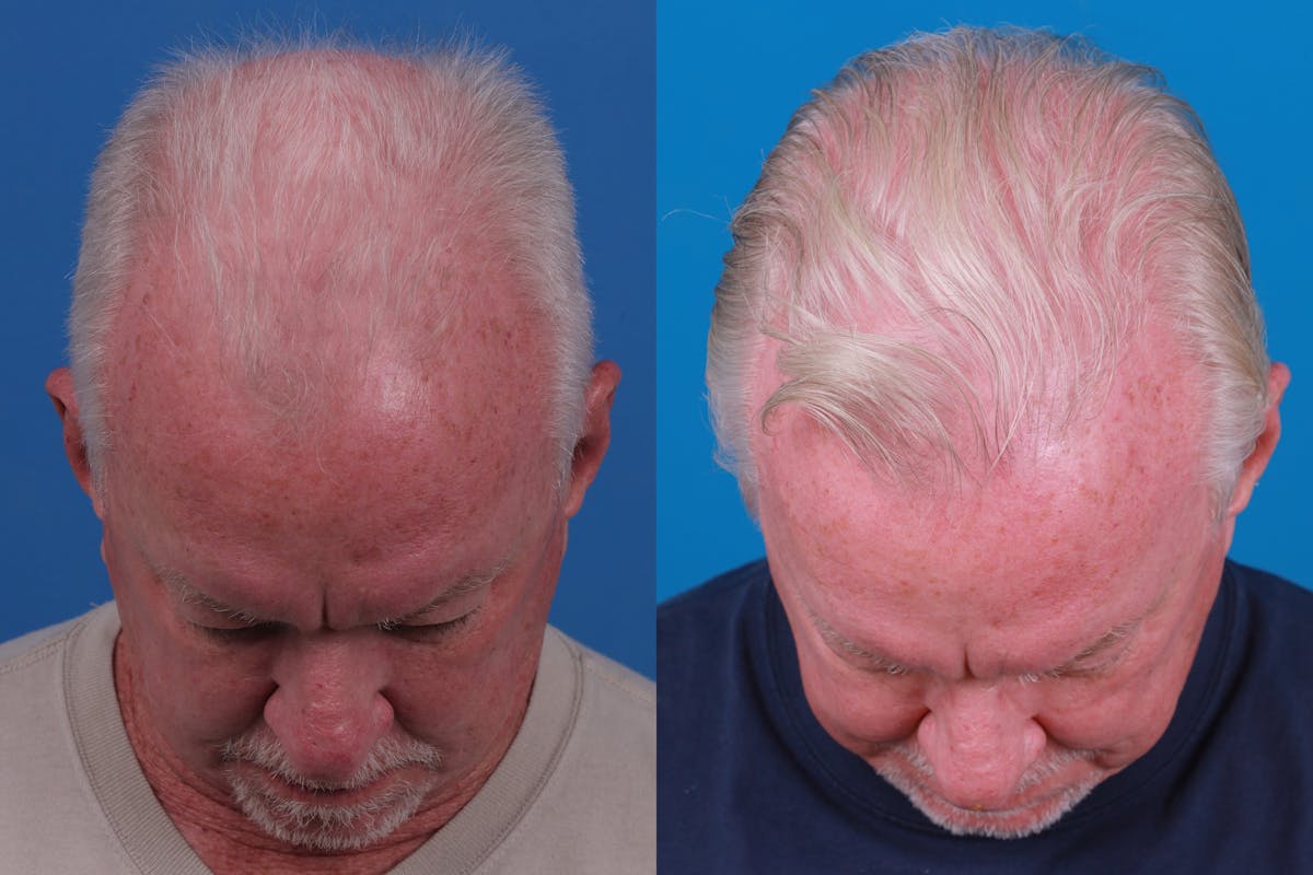 Hair Restoration Before & After Gallery - Patient 286463 - Image 3