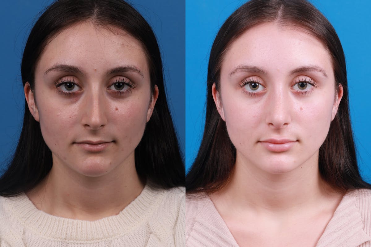 Rhinoplasty Before & After Gallery - Patient 898500 - Image 1