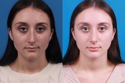 Rhinoplasty Before & After Gallery - Patient 898500 - Image 1