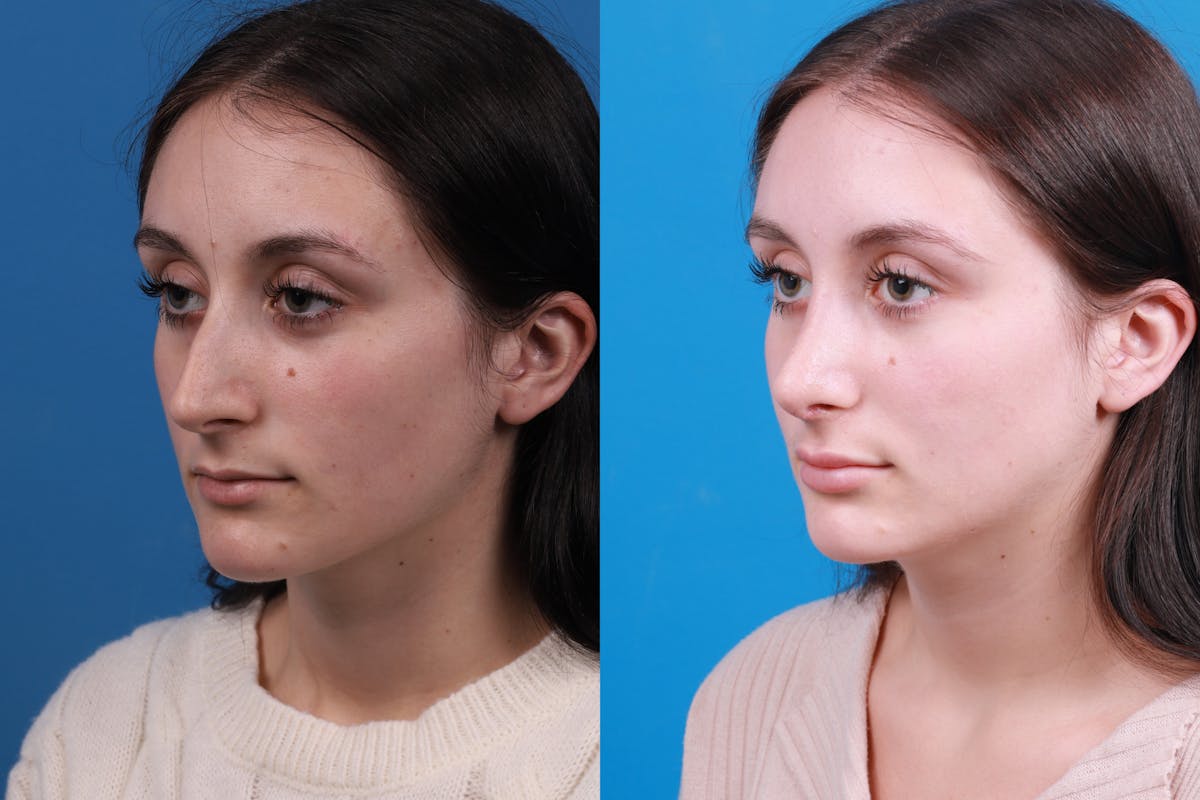 Rhinoplasty Before & After Gallery - Patient 898500 - Image 2