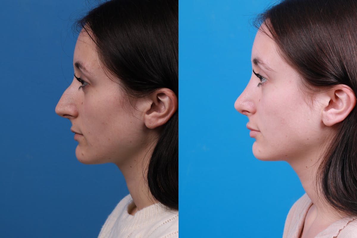 Rhinoplasty Before & After Gallery - Patient 898500 - Image 3