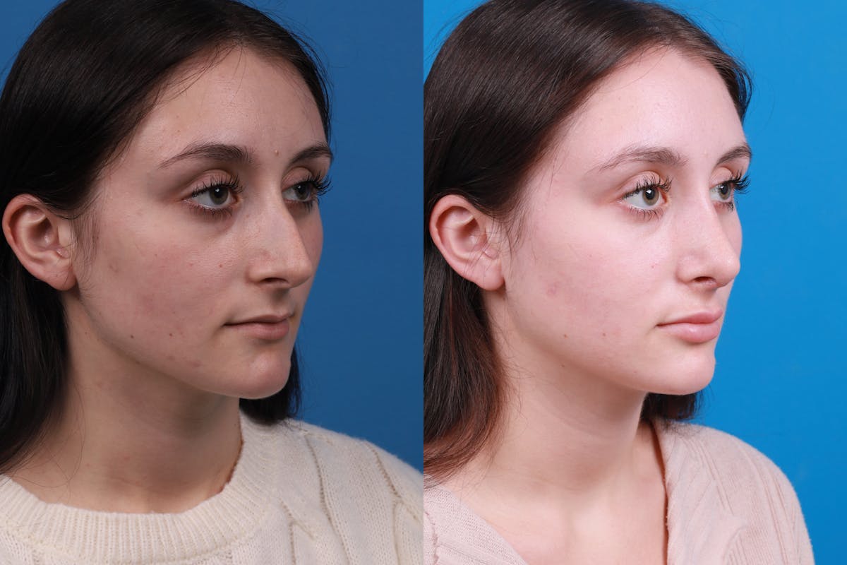 Rhinoplasty Before & After Gallery - Patient 898500 - Image 4
