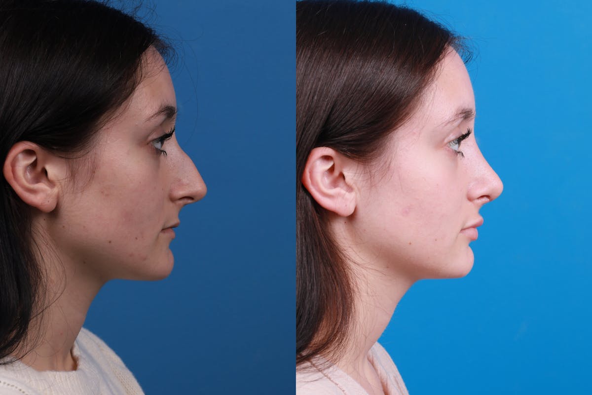 Rhinoplasty Before & After Gallery - Patient 898500 - Image 5