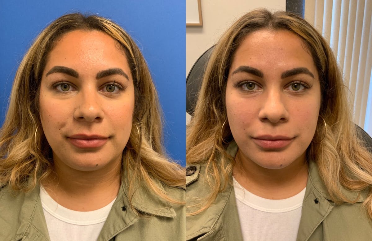 Dermal Fillers Before & After Gallery - Patient 145135 - Image 1