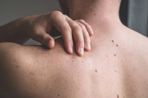 person with moles on their back