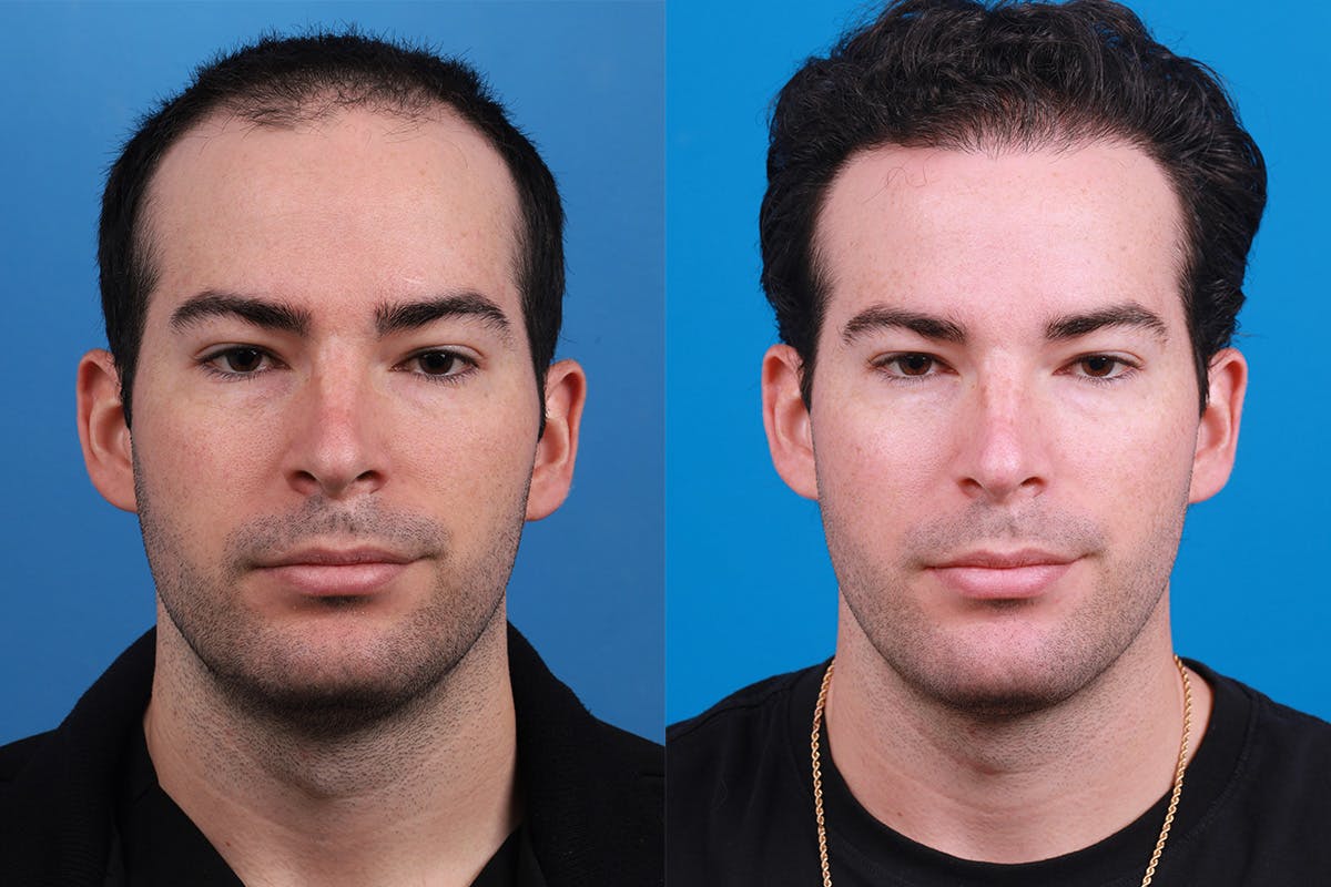 Hair Restoration Before & After Gallery - Patient 377984 - Image 2