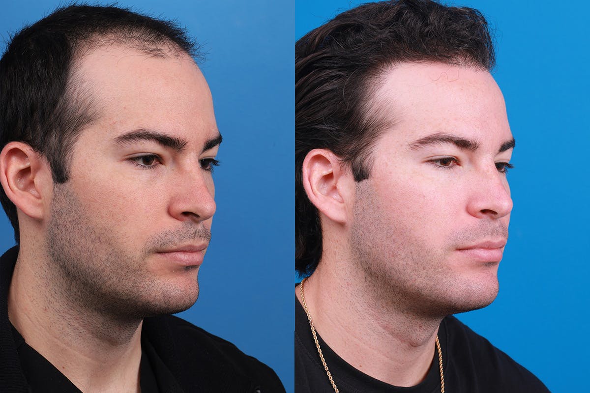 Hair Restoration Before & After Gallery - Patient 377984 - Image 3