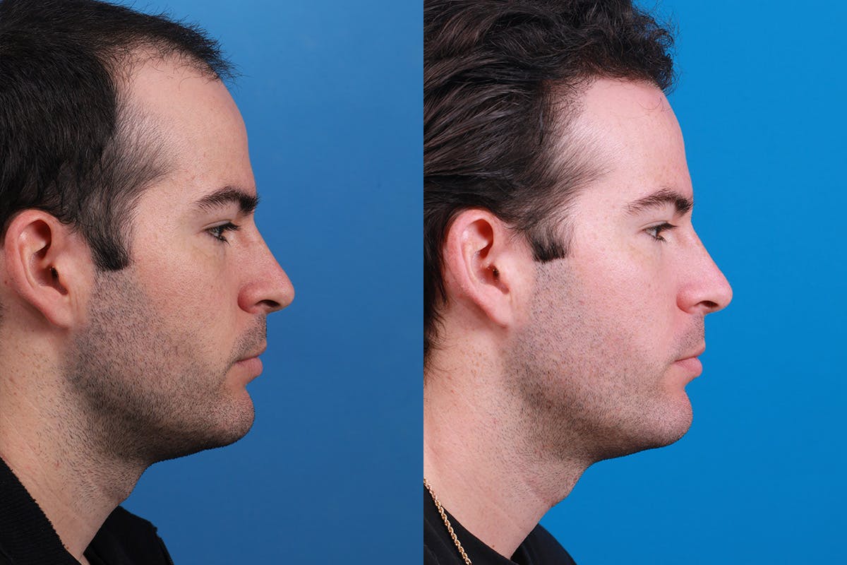 Hair Restoration Before & After Gallery - Patient 377984 - Image 4