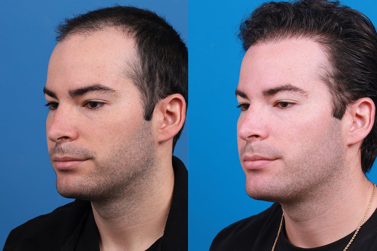 Hair Restoration Before & After Gallery - Patient 377984 - Image 5