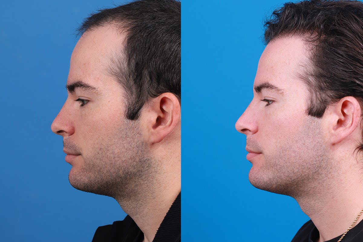 Hair Restoration Before & After Gallery - Patient 377984 - Image 6
