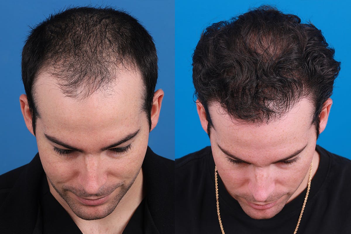 Hair Restoration Before & After Gallery - Patient 377984 - Image 1