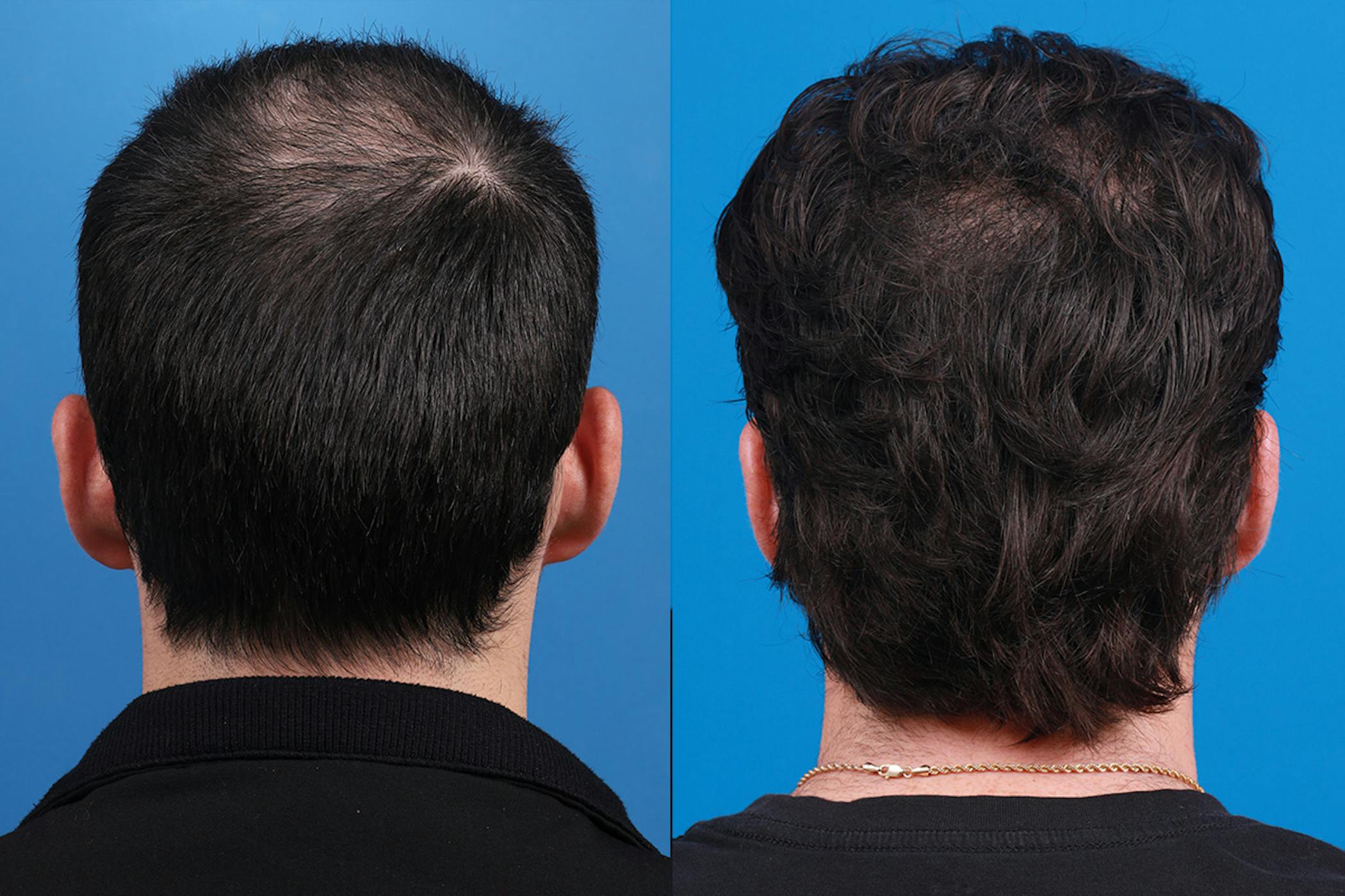 Hair Restoration