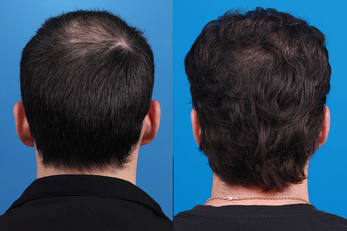 Hair Restoration Before & After Gallery - Patient 377984 - Image 7