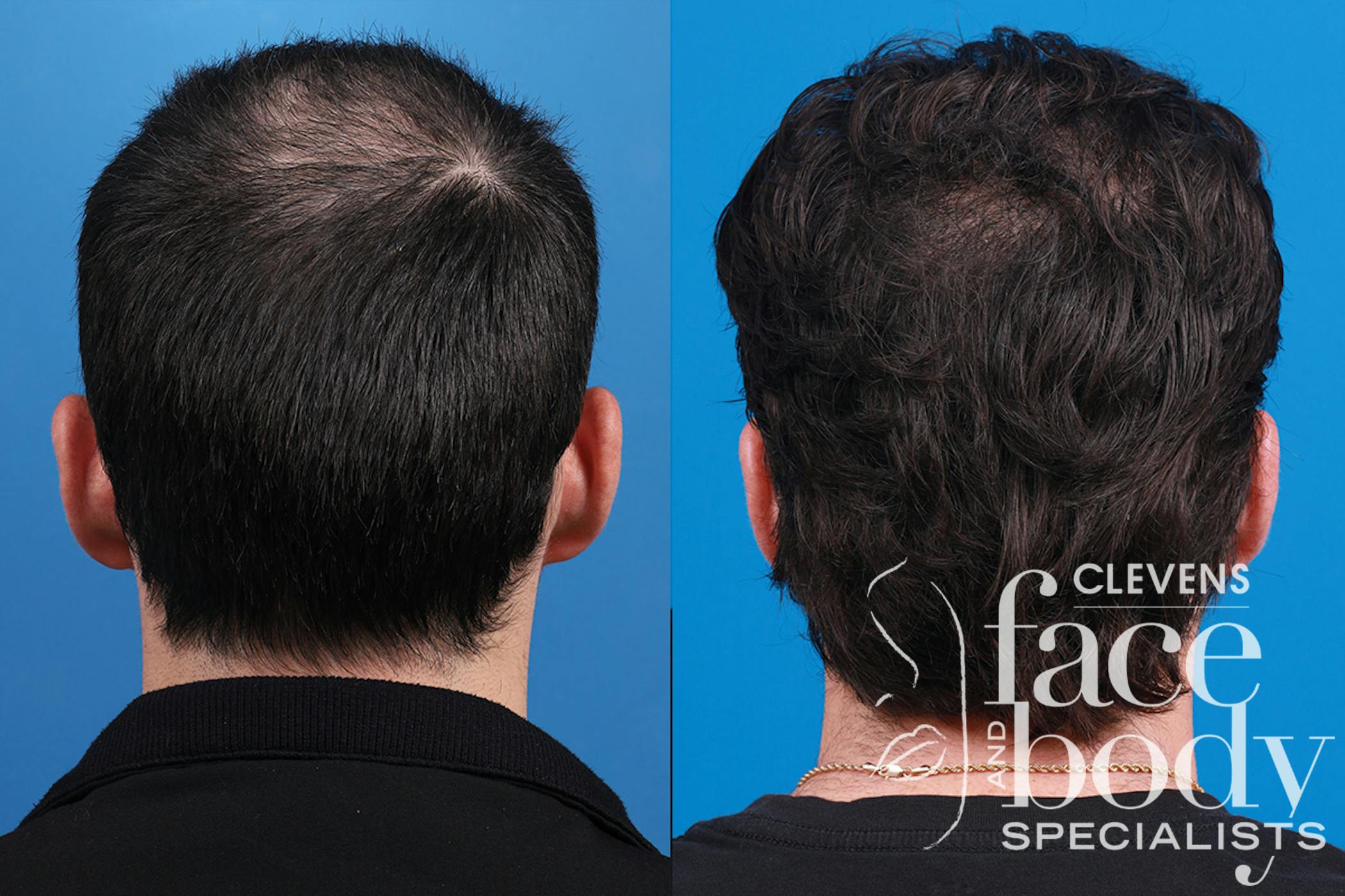 Hair Restoration