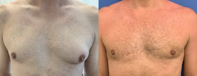 Male Breast Reduction (Gynecomastia) Before & After Gallery - Patient 487757 - Image 1