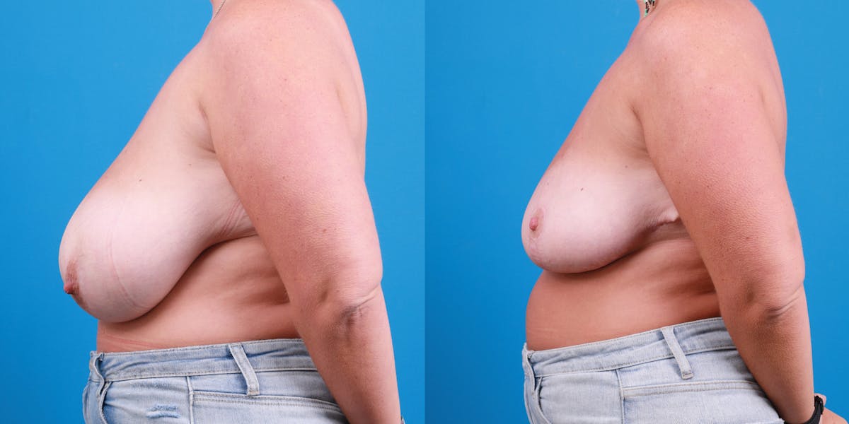 Breast Reduction Before & After Gallery - Patient 420283 - Image 3