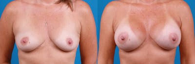 Breast Augmentation Before & After Gallery - Patient 402439 - Image 1